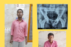 PELVIS FRACTURE